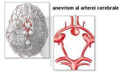 anevrism-1